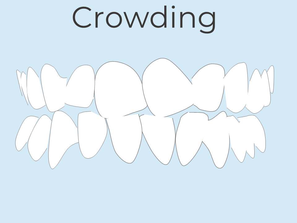Teeth crowding orthodontic treatment