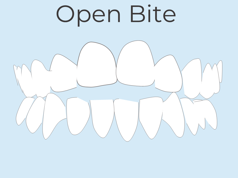 Teeth open bite orthodontic treatment