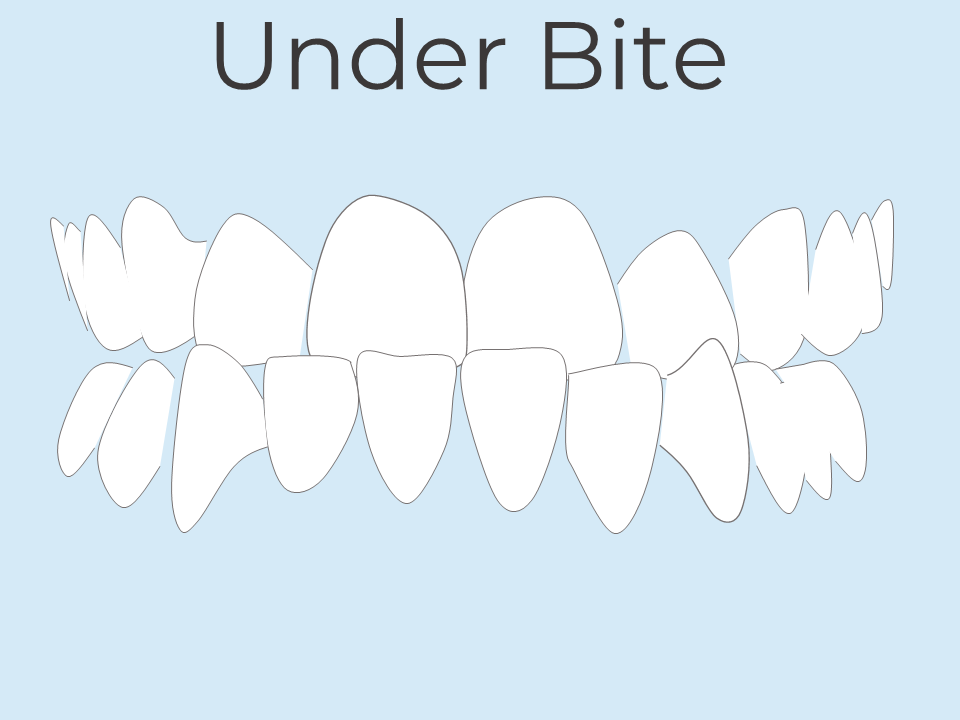 Teeth under bite orthodontic treatment